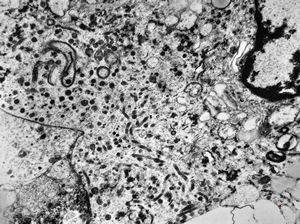 M,63y. | adrenal - neuroblastoma